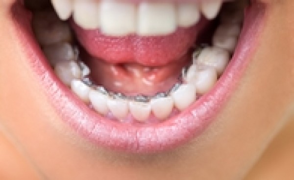 Orthodontie Linguale